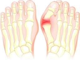 Energiesystem: Emotionale Heilung Valgus (Fehlstellung des Fußes) - Fernausbildung!